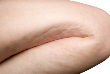 Was hilft gegen Cellulite?