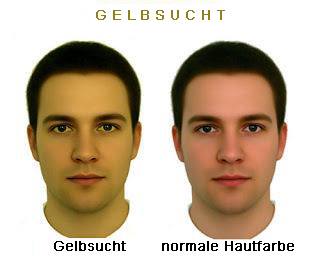 Gelbsucht