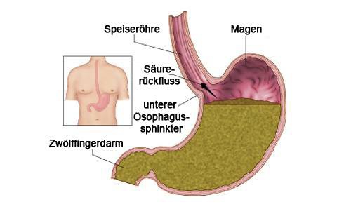 Sodbrennen - Behandlungsmöglichkeiten