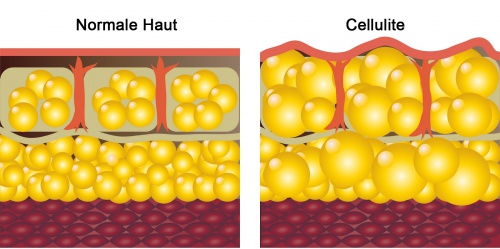 cellulite
