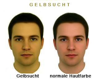 gelbsucht