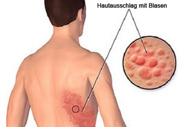 Herpes Zoster natürlich behandeln