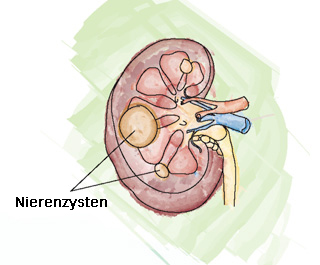 Illustration einer Niere mit Zysten