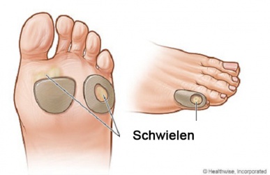 Schwielen natürlich behandeln