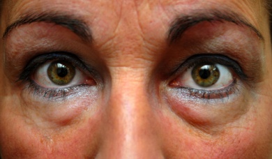Schwellungen unter den Augen behandeln