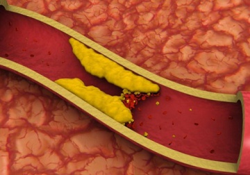 Hohe Cholesterinwerte natürlich senken
