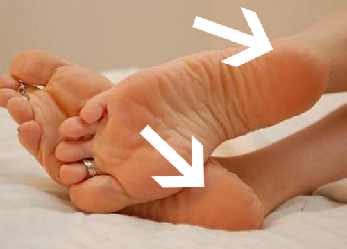 Plantarfasziitis