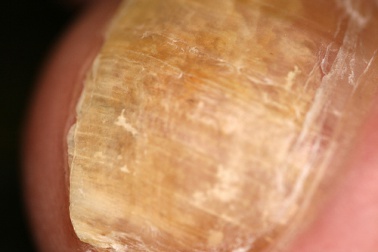 Nagelpilz: wenn Pilze unsere Nägel besiedeln