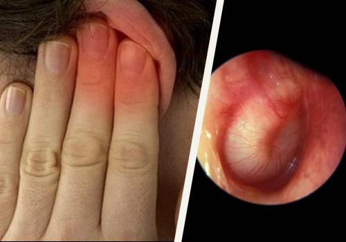 Tipps gegen Druck auf den Ohren und Ohrverstopfung