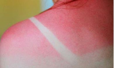 Was kann man gegen Sonnenbrand tun?