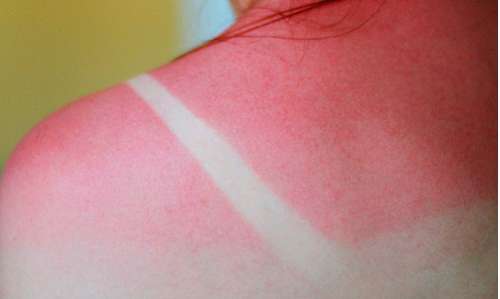 Sonnenbrand ist sehr schädlich