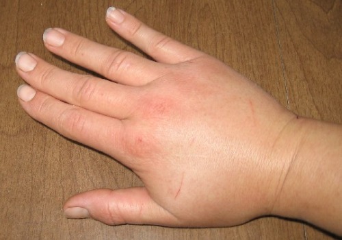 geschwollene-Hand