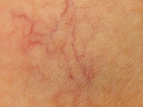 9 Tipps zur Vorsorge gegen Besenreiser