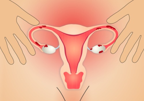 Richtige Ernährung bei Endometriose