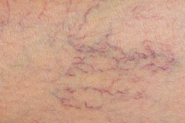 Krampfadern; Tipps für eine bessere Durchblutung