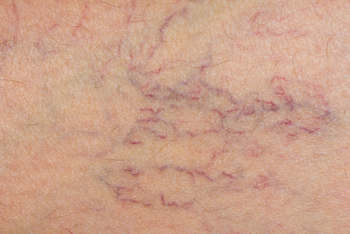 Krampfadern: Tipps für eine bessere Durchblutung Krampfadern: Tipps für eine bessere Durchblutung