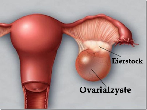 Ovarialzysten rechtzeitig entdecken und behandeln