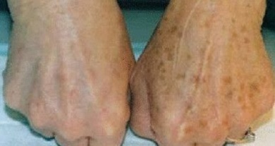 Hautflecken an den Händen - Tipps zur Verringerung