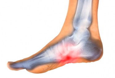 Plantarfasziitis: Was ist das und was hilft dagegen?