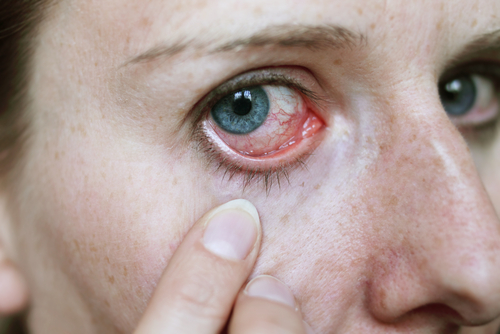 Natürliche-Behandlungen-gegen-gerötete-und-trockene Augen