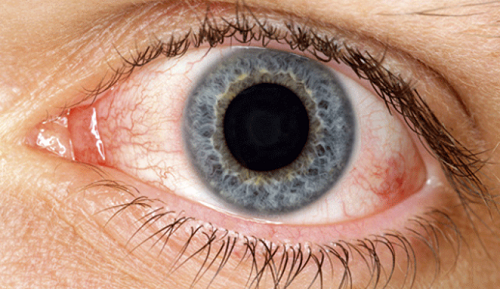 Natürliche Hausmittel gegen trockene Augen