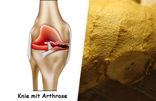 Wie kann man Arthrose behandeln? Wie kann man Arthrose behandeln?