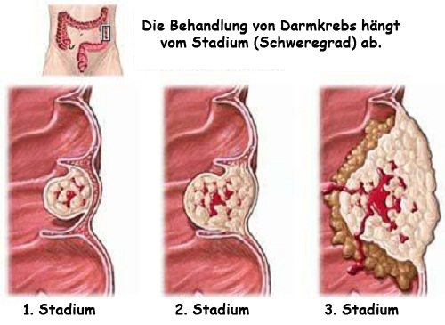 Wissenswertes über Darmkrebs Wissenswertes über Darmkrebs
