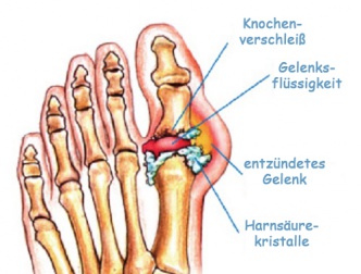 Harnsäure ausleiten