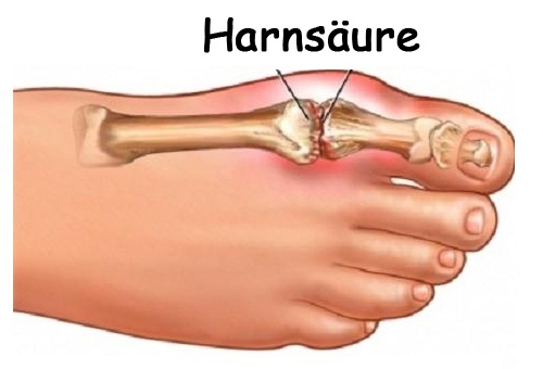 Harnsäure