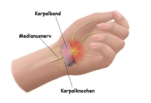 Karpaltunnelsyndrom behandeln: 5 schmerzlindernde Tipps