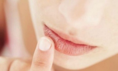 Hausmittel, die gegen Herpes helfen können