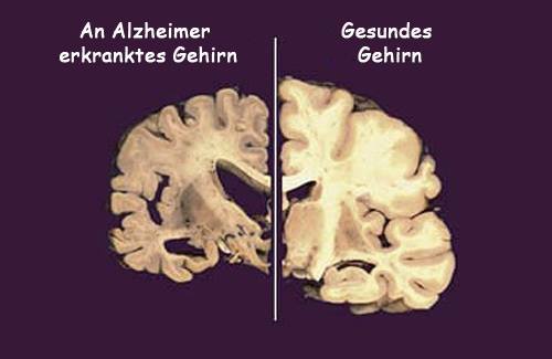 Verursacht Schlafmangel Alzheimer?