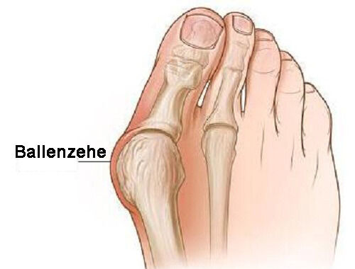 ballenzehe