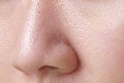 Erweiterte Poren machen sich oft im Nasenbereich bemerkbar