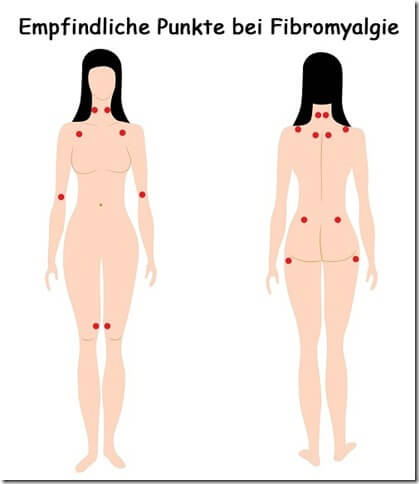 fibromyalgie-illustartion