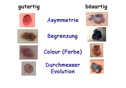 Warnsignale für Hautkrebs: Anzeichen und Symptome eines Melanoms