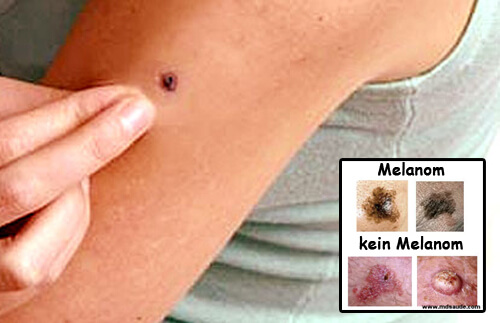 melanom2