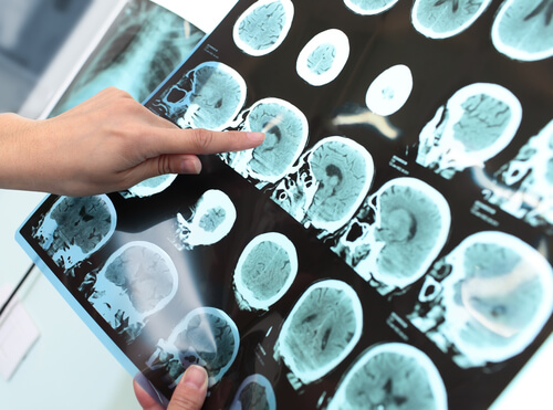 5 Ratschläge, wie du Alzheimer vorbeugen kannst 5 Ratschläge, wie du Alzheimer vorbeugen kannst
