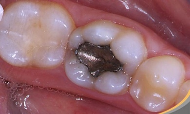Gesundheitsrisiko durch Amalgam?