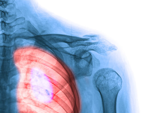 Atemwegebeschwerden als Lungenkrebs erkennen