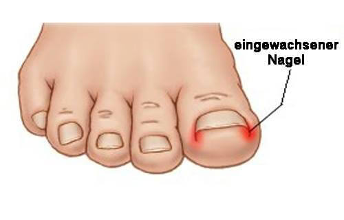 Eingewachsener-Nagel