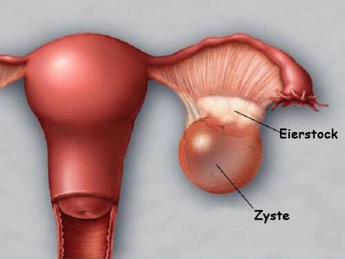 Ovarialzyste - Bauchschmerzen