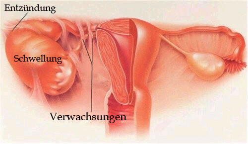 Unterleibsentzündung - Symptome & Vorbeugung