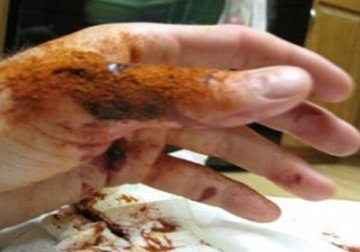 Pflanzliches Gel soll Blutungen in 10 Sekunden stoppen