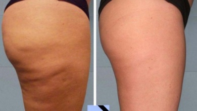 Einfache, hausgemachte Cellulite-Behandlungen