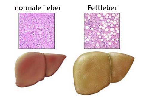 Wie entsteht die Fettleber und wie behandelt man sie?