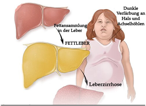 Fettleber - Symptome erkennen
