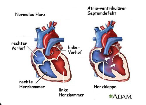 Was sind Herzgeräusche? - 7 Symptome