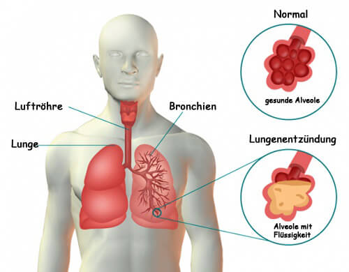 Lungenentzündung: Symptome und unterstützende Naturheilmittel