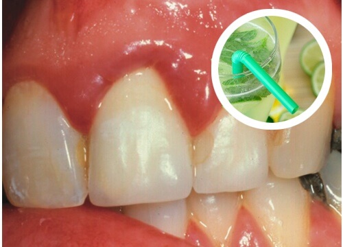 Wirksames, selbstgemachtes Mundwasser gegen Zahnfleischbluten